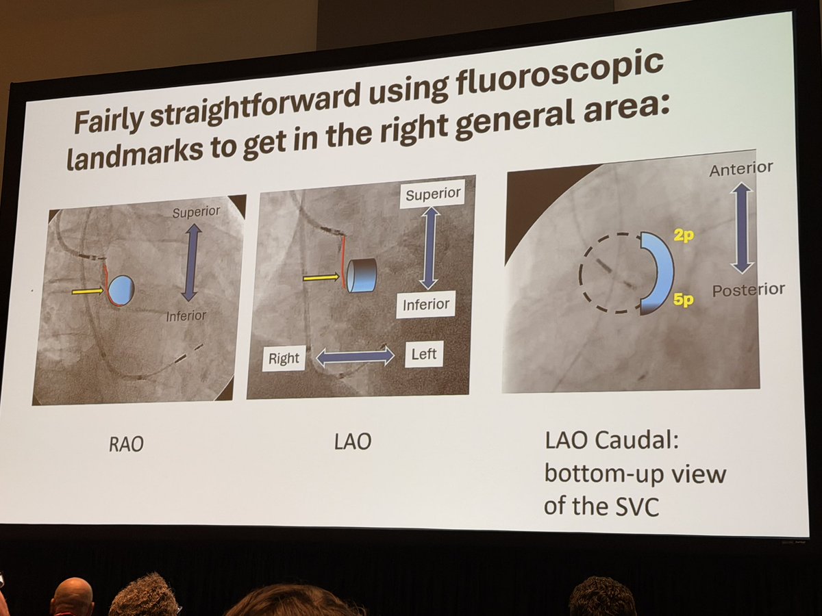 simovicst's tweet photo. 1/9
🔴 Bachmann Bundle Pacing (BBP) — Daniel Lustgarten

Fluoroscopy alone is NOT enough. Using fluoro only, just half of patients met criteria for true Bachmann Bundle capture. True BB capture correlates with a sustained, significant reduction in AF incidence and burden. (Infeld et al., Europace 2022)