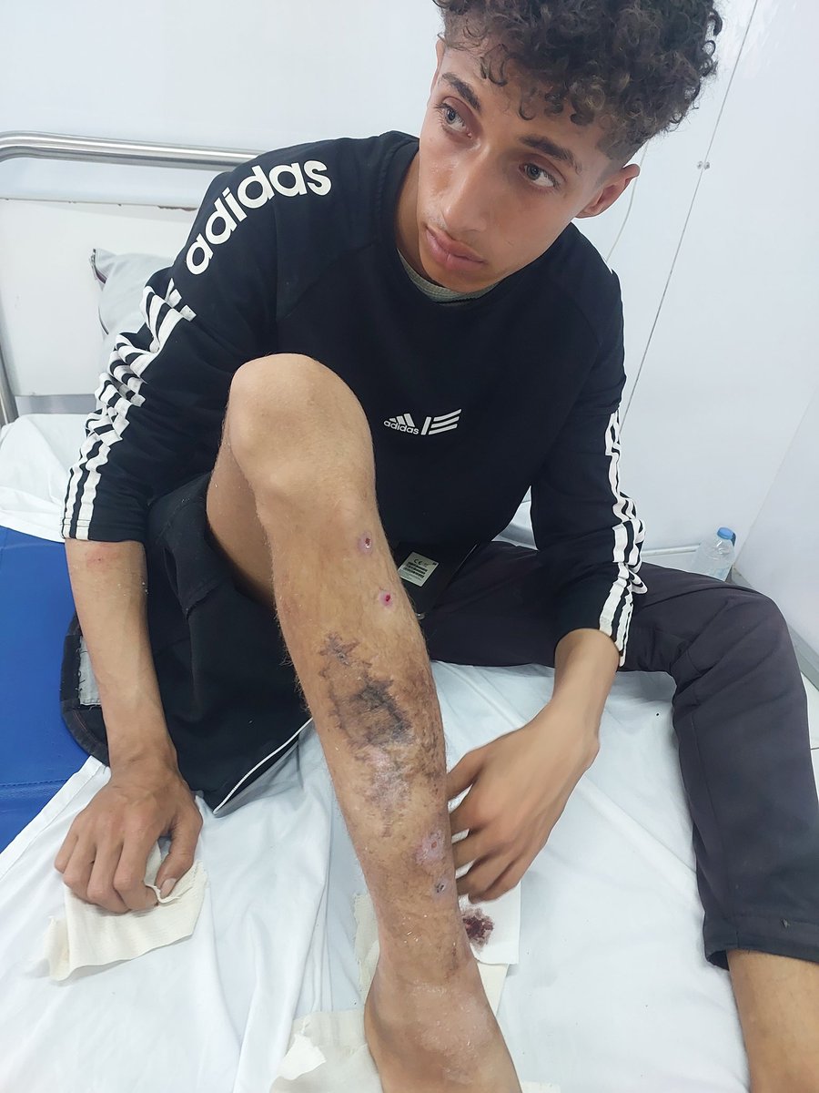wdmr28280815's tweet photo. This is my brother's leg. Look at it, it breaks my heart. We are from Gaza and no one pays attention to us, no one sees our suffering. My dear friends, my brother Majed is in pain and needs your help. Please don't let my brother suffer.😢😭
https://t.co/OJ4FRArqSy https://t.co/1KbTkOmW3w