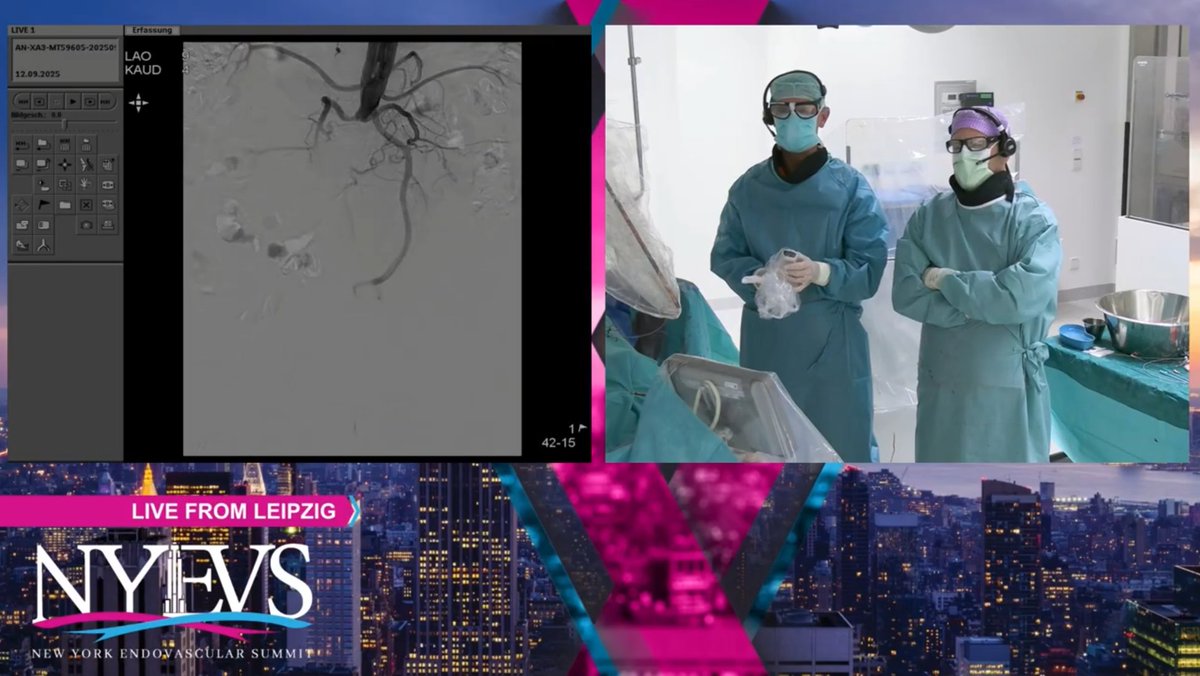EndovascularNy's tweet image. Get ready for #NYEVS2026 by revisiting a live case from last year’s symposium—broadcast from University of Leipzig Medical Center in Leipzig, Germany.

Watch the full case here:
youtube.com/watch?v=16UxOn…

#cardiology #interventionalcardiology #peripheralarterialdisease
