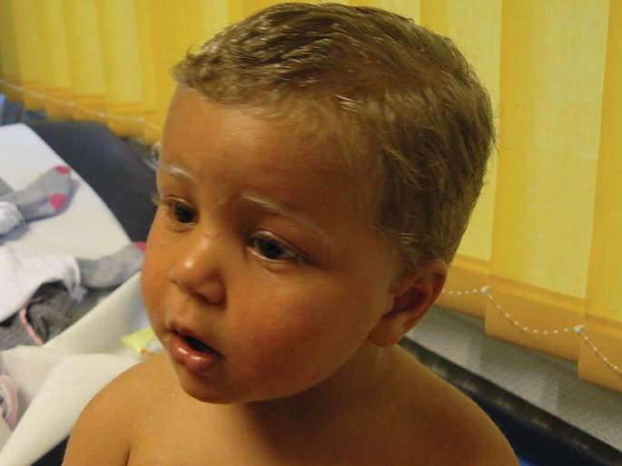 PeterItebimien's tweet image. A 3yr ♂️ with history of multiple hospital admissions for recurrent infections presented with persistent fever,lethargy,poor weight gain.O/E hepatosplenomegaly.FBC shows cytopenia,elevated ferritin. What is the diagnosis? What is this syndrome? Management? 
#MedX #MedTwitter