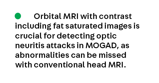 ContinuumAAN's tweet image. Key Point 2 from the article Myelin Oligodendrocyte Glycoprotein Antibody–Associated Disease by Eoin P. Flanagan and Cheryl Hemingway from the April #MultipleSclerosis and Related Disorders issue, which is available to subscribers at hubs.la/Q04ccBWb0. #NeuroTwitter #MedEd