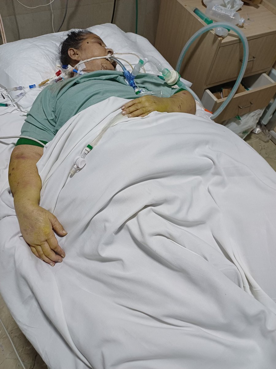 Rajiv3S's tweet image. गलत दवाइयों और डॉक्टर्स की लापरवाही की वजह से हमारी मां की जान चली गई। दीपक कैलाश हॉस्पिटल कड़कड़डूमा, दिल्ली मरीज का इलाज नहीं सिर्फ बिल बनाकर पैसों की लूट करता है। वर्तमान में नोएडा के सांसद का यह हॉस्पिटल लूट का अड्डा बना हुआ है। 
#KailashHospital #Delhi #noida