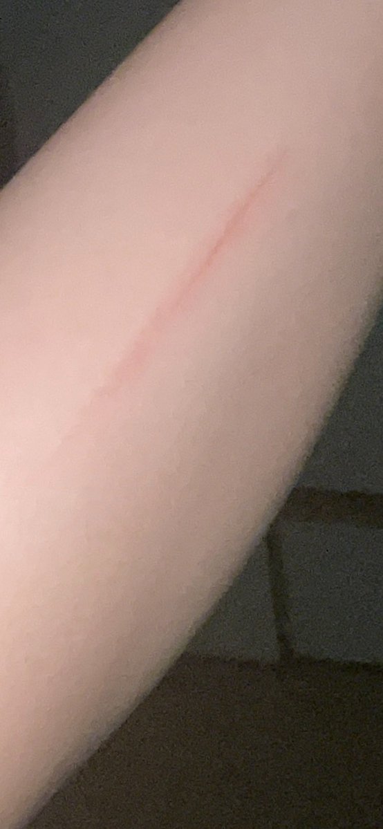 腕怪我した。