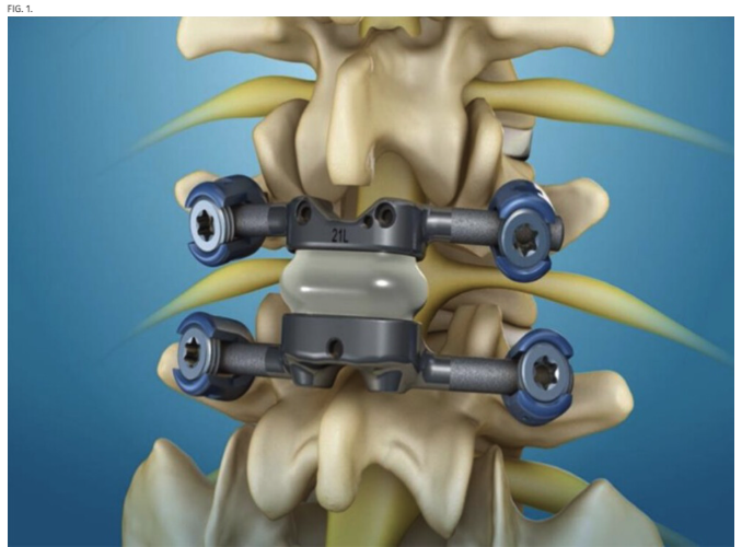 TheJNS's tweet photo. #JNSCaseLessons. Researchers highlight use of total posterior spine system (TOPS) facet arthroplasty in management of patient with post-fusion adjacent segment disease. 

https://t.co/fViqKh8OdL https://t.co/sqsd74IO5J