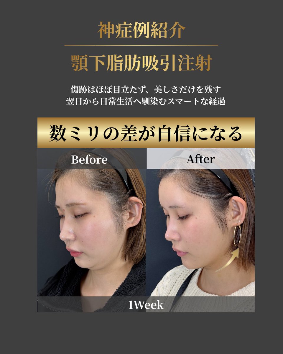 小顔輪郭整形 | 小顔KING(濱田純) / イテウォン名古屋栄院 tweet media