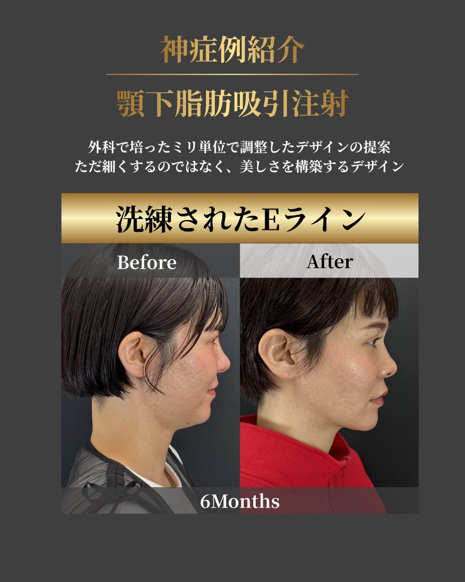 小顔輪郭整形 | 小顔KING(濱田純) / イテウォン名古屋栄院 tweet media