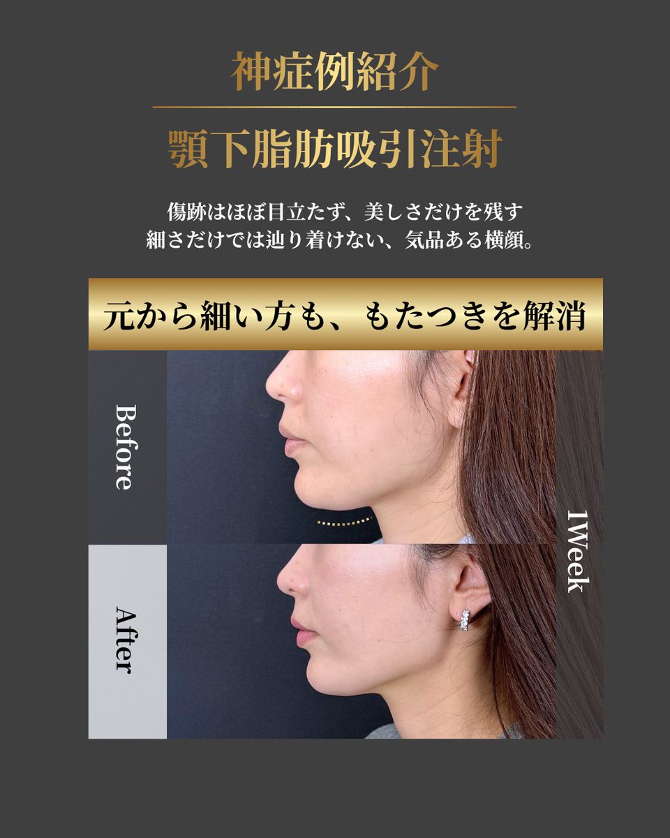 小顔輪郭整形 | 小顔KING(濱田純) / イテウォン名古屋栄院 tweet media