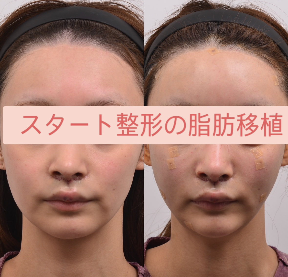 スタート整形外科&ヨンセUP整形病院の案内 tweet media