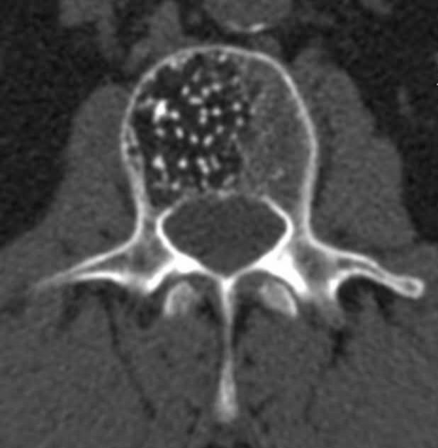 albertoortegana's tweet image. A 45-year-old man undergoes CT imaging of the spine for chronic back pain. The axial CT image of the vertebra is given below. What is the most likely diagnosis?

#radiology #medicine #surgery #medical #neetpg 
@Ausbones @Dr_Shiv_kumar_ @drobiy12 @hemo_shk @shakilED
