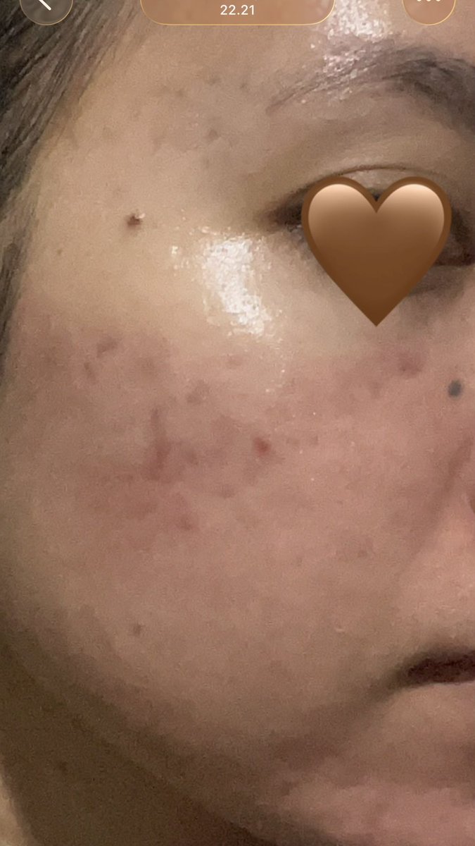 bubiiyum's tweet photo. acne prone skin? jerawat bandel yg gak sembuh sembuh?

aku akhirnya nemu skincare yg beneran works, dalam ±1 bulan jerawatku jauh lebih kalem!!

mau sharing bgtt ke sesama acne fighter kuuu🫰

from this                        to this https://t.co/t3CvwuO4o9