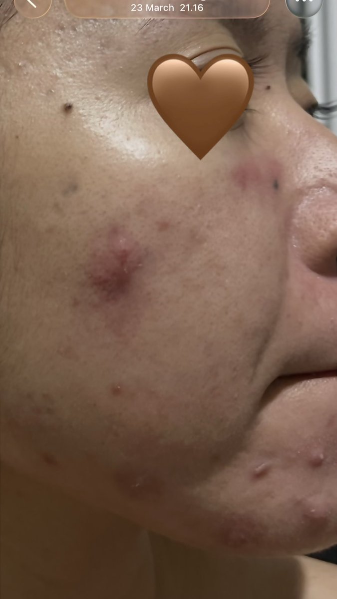 bubiiyum's tweet photo. acne prone skin? jerawat bandel yg gak sembuh sembuh?

aku akhirnya nemu skincare yg beneran works, dalam ±1 bulan jerawatku jauh lebih kalem!!

mau sharing bgtt ke sesama acne fighter kuuu🫰

from this                        to this https://t.co/t3CvwuO4o9