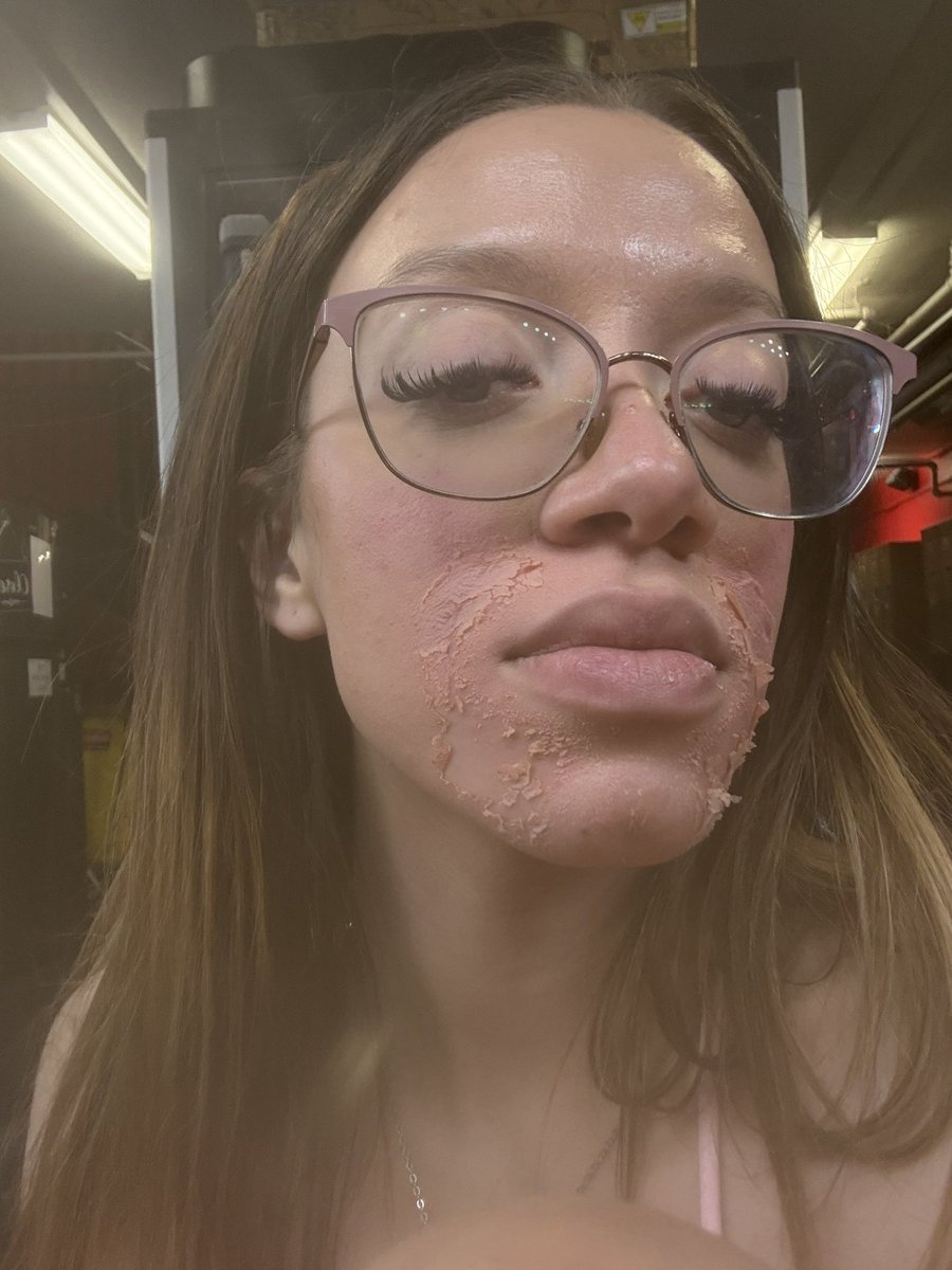 I got another chemical peel yall and this time the peel is INSANE 🤣🤣 

All night I didn’t smile or laugh bc I KNEW the peel was gonna be intense so I finally let myself smile when I was leaving and this was the result 🤣