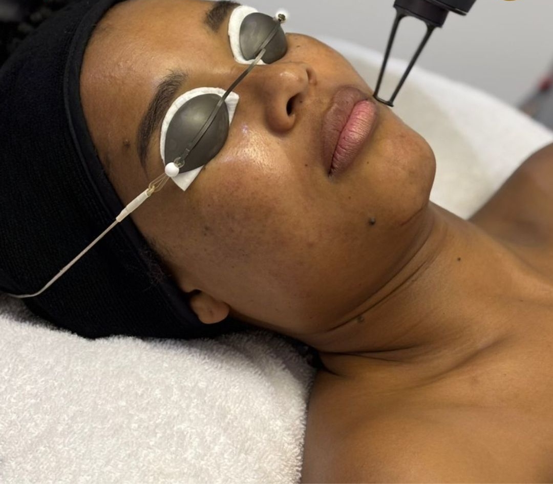 SkinBodyRenewal's tweet image. Don’t underestimate the power of a medical laser facial. Get that glow back in time for the festive season with PICO toning. Here's how brnw.ch/21x1Vll 

#SkinRenewalSA #skin #beauty #aesthetics #medicalaesthetics #lasers #DrLed #skindoctors