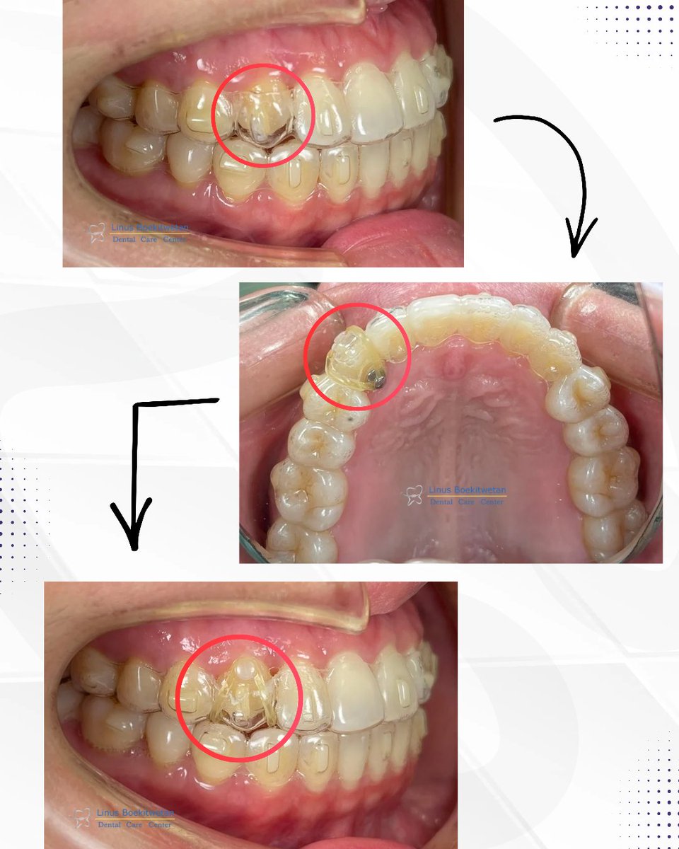 DrgLinus's tweet photo. Button and elastic for non tracking tooth in clear aligners 

#drglinus #cleraligners #aligner #behelgigi #beheltransparan #alignertroubleshooting https://t.co/l0HWFX319W