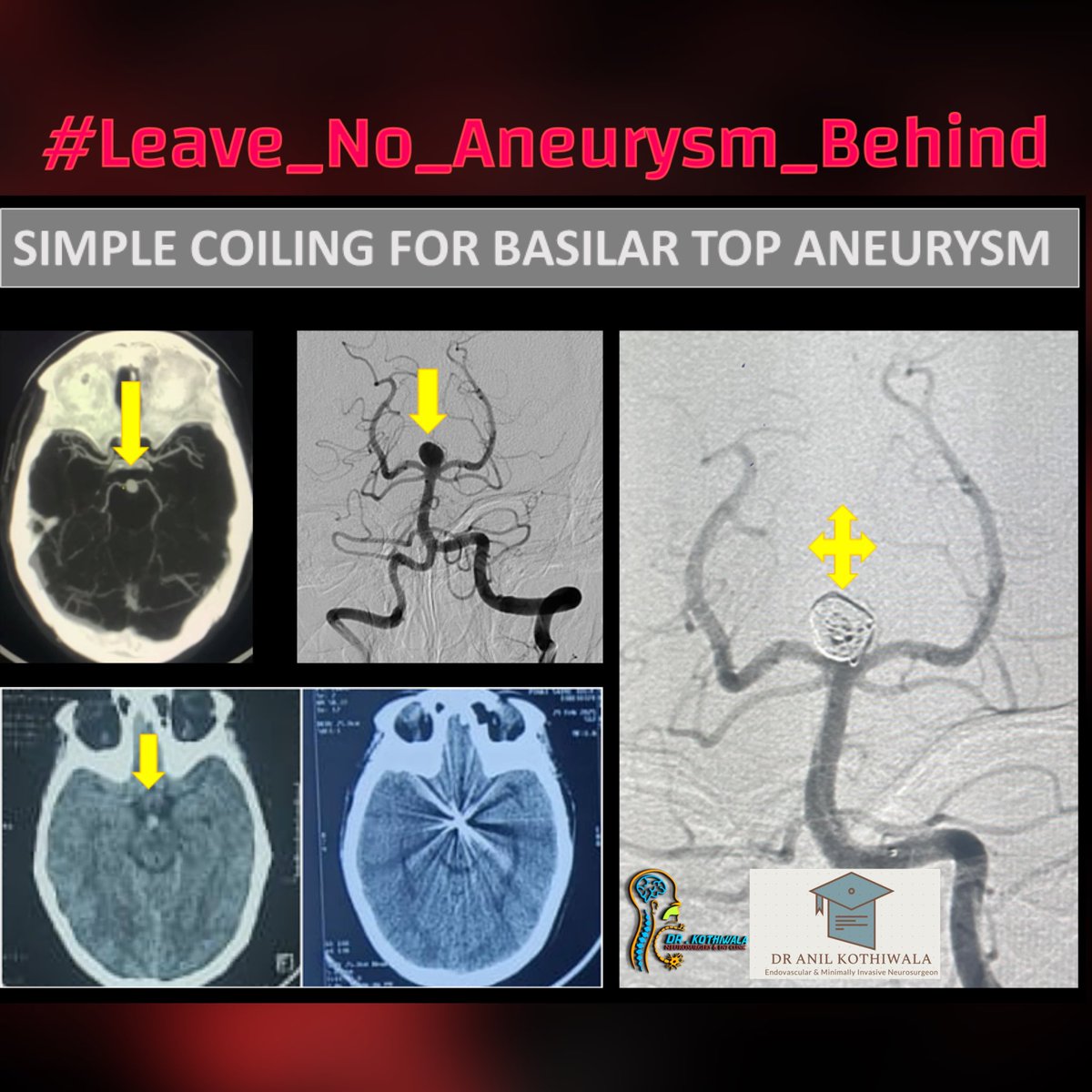 KothiwalaNeal's tweet photo. Endovascular Coiling for Basilar Top Aneurysm

#aneurysmcoiling 
#Neurosurgery https://t.co/Uq1IcW1HE1