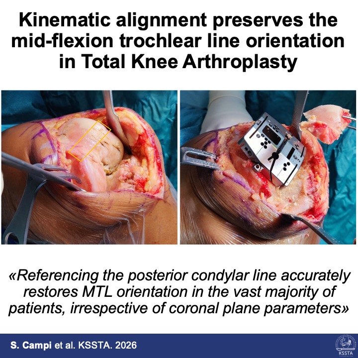 KSSTA's tweet image. Kinematic alignment in TKA preserves mid-flexion trochlear line orientation in most patients, supporting its anatomical and biomechanical rationale. #TKA #Knee#Orthopaedics #Arthroplasty #KinematicAlignment
Read more here: doi.org/10.1002/ksa.12…
