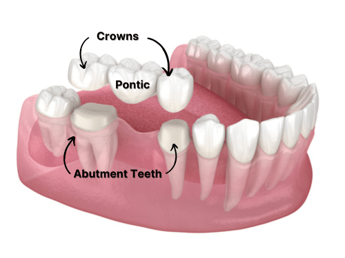 RivieraDC's tweet image. In this video, Dr. Thomas Hanson provides an overview of traditional dental bridges, highlighting their structure and benefits. bit.ly/44ALQ0c #foley #alabama #dentalimplants #dentist