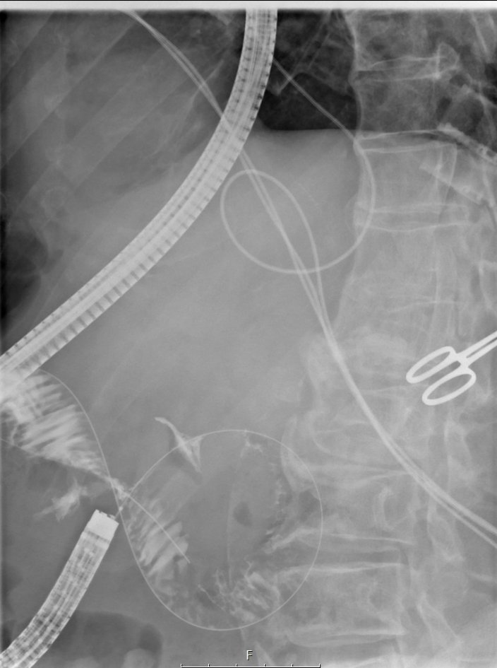 AfectoEdgar's tweet image. EUS gastrojejunostomies are both fun to do and really life changing on terms of gastric outlet obstruction palliation. Win-win
#eus #endoscopy #interventionalendoscopy #therapeuticeus