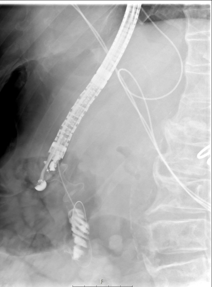 AfectoEdgar's tweet image. EUS gastrojejunostomies are both fun to do and really life changing on terms of gastric outlet obstruction palliation. Win-win
#eus #endoscopy #interventionalendoscopy #therapeuticeus