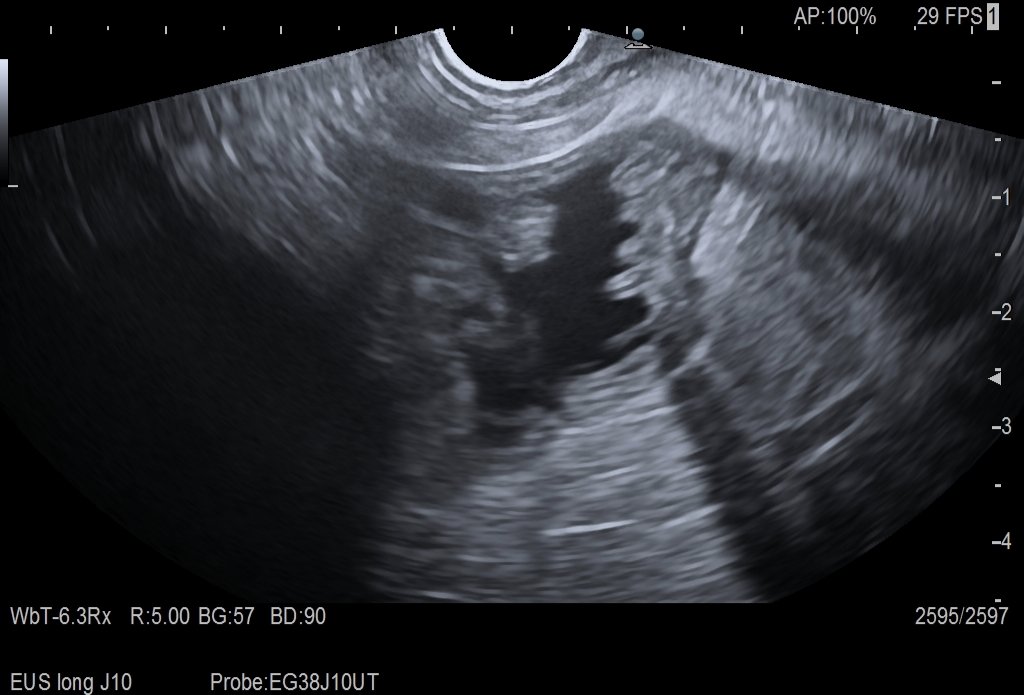 AfectoEdgar's tweet image. EUS gastrojejunostomies are both fun to do and really life changing on terms of gastric outlet obstruction palliation. Win-win
#eus #endoscopy #interventionalendoscopy #therapeuticeus