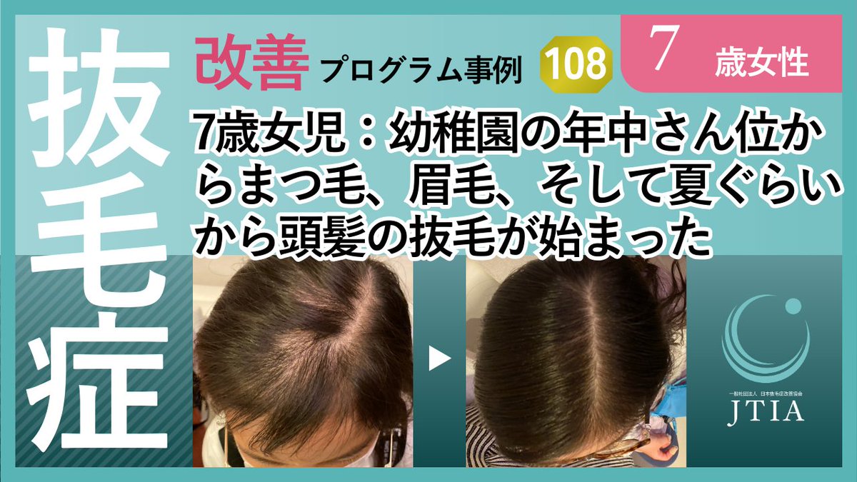 tricho_jtia's tweet photo. ★抜毛症改善事例108：7歳女性：幼稚園の年中さん位からまつ毛、眉毛、そして夏ぐらいから頭髪の抜 | ダメージヘア改善・抜毛症改善はビョウインからビヨウインの時代へ／抜毛症に伴う、うつ・不登校・引きこもりを改善を手助け
 https://t.co/WhGz27VfXV #Amebaブログ #アメブロ https://t.co/drfm7OVZzn