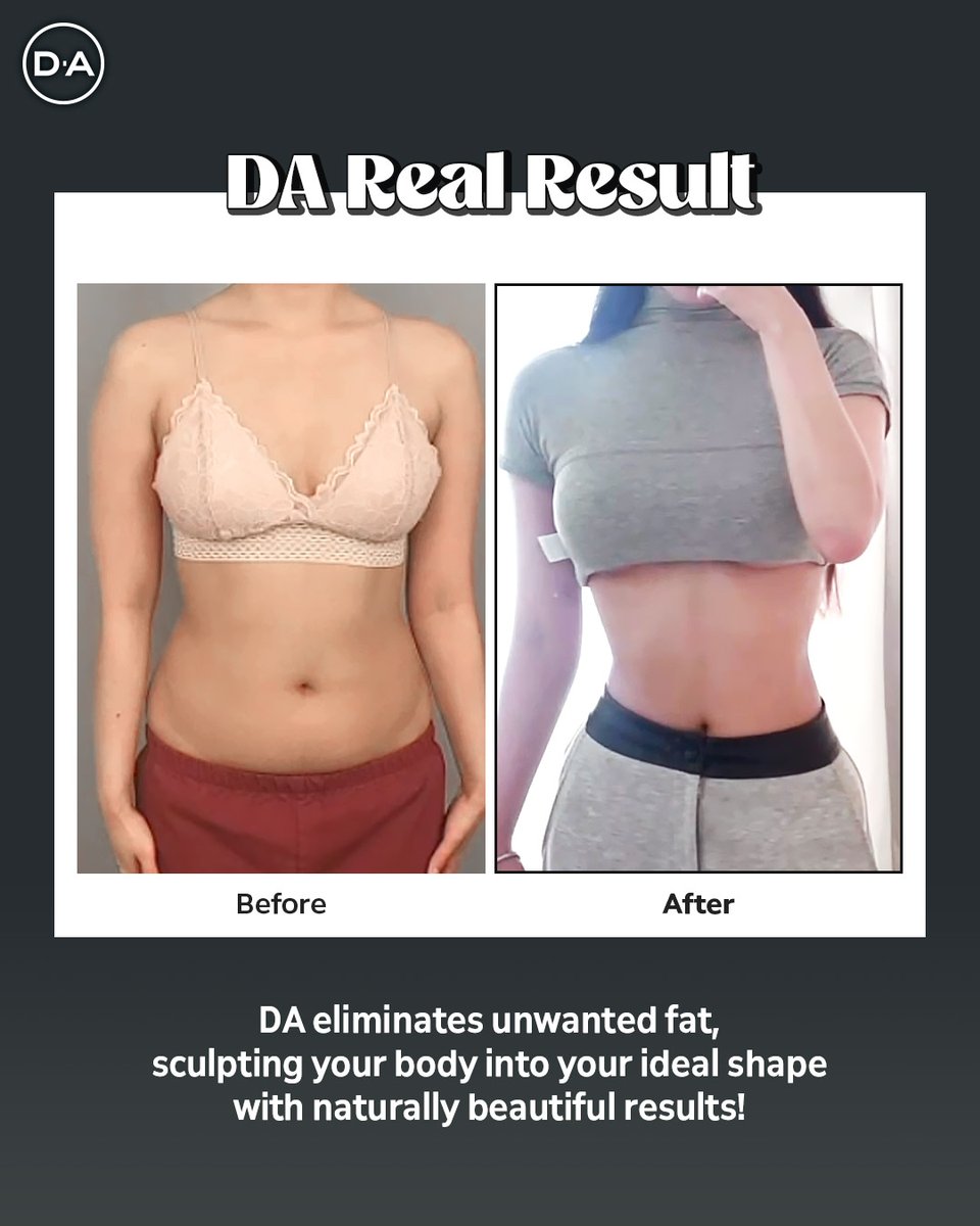 daprs1's tweet image. Sculpt your confidence, not just your body ✨
✔️ Target stubborn fat
✔️ Enhance natural contours
✔️ Achieve a more balanced silhouette
Every body is different, and so is every result. 
Consultation is key 🔍

☎️+82 10 9763 7112 ENG/ESP
#plasticsurgery #lipo #bodygoals #seoul