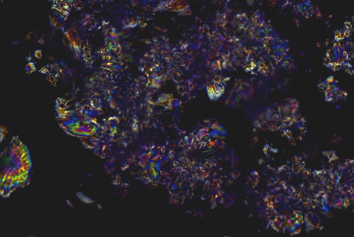 mysadwhale's tweet image. Oxalate nephropathy #path #pathology #micro #histology #polarization