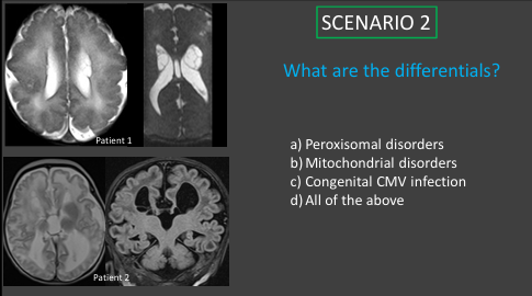 The_ASPNR's tweet photo. Dr. Asthik Biswas (@stikkman11) reminds us that malformations of cortical development are common in certain metabolic disorders such as peroxisomal disorders. Hypomyelination is another important clue to diagnosis. #pedsrad #pedineurorad #radres #FOAMrad https://t.co/xY3W6M46Ru