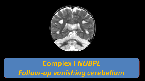 The_ASPNR's tweet photo. Dr. Cesar Alves (@cesaralvesneuro) shows cerebellitis-like presentation and basal ganglia lesion in the mitochondrial disorder ATP6. Increased blood lactate and decreased citrulline suggestive. If white matter change + cerebelitis-like, think about NUBPL.  #pedineurorad #pedsrad https://t.co/zQgZMlWlXD