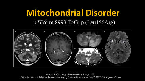 The_ASPNR's tweet photo. Dr. Cesar Alves (@cesaralvesneuro) shows cerebellitis-like presentation and basal ganglia lesion in the mitochondrial disorder ATP6. Increased blood lactate and decreased citrulline suggestive. If white matter change + cerebelitis-like, think about NUBPL.  #pedineurorad #pedsrad https://t.co/zQgZMlWlXD