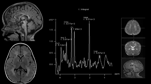 The_ASPNR's tweet photo. Dr. Cesar Alves (@cesaralvesneuro) shows illustrative examples of DARS mutation related HBSL and LBSL. Sparing of intraxial segmental trigeminal nerve common with DARS1 but rare in DARS2. #PediNeuroRad #radres #pedsrad https://t.co/nlm9N9vt79