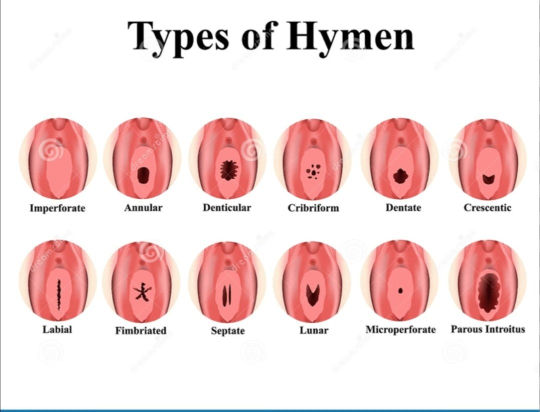TMedicalpost's tweet photo. Bro to bro,

1. Not all virgins bleed the first time they have sex.

2. The hymen is a thin membrane that partially covers the vaginal opening.

3. All women have different types of hymens.

4. Some have thick hymens, some have thin hymens, and some may not have No hymens at all.

5. Some women have larger hymens while some naturally have little amount that covers a small portion of their vaginal opening.

6. In some women the hymen wears away on its own with exercise, bicycling, horse riding even dancing or using tampon.

7. If a woman is born without a hymen she won't bleed the first day she has sex.

8. Women who does bleed the first day they had sex are the ones with thick hymens which are the younger girls.

9. 16 year old girl has a higher chance of bleeding than a 25 year old woman.

10. Most women who bleed the first day are the ones who dealt roughly during sex.

11. If a guy forces himself inside a woman when she's ready relaxed and aroused enough will likely cause injury and bleeding. 

12. Bleeding the first time does not necessarily mean the hymen was broken. It can be due to pain, lack of arousal, or injury.

13. Bleeding does not have anything to do with virginity, it has to do with a kind of hymens she has.