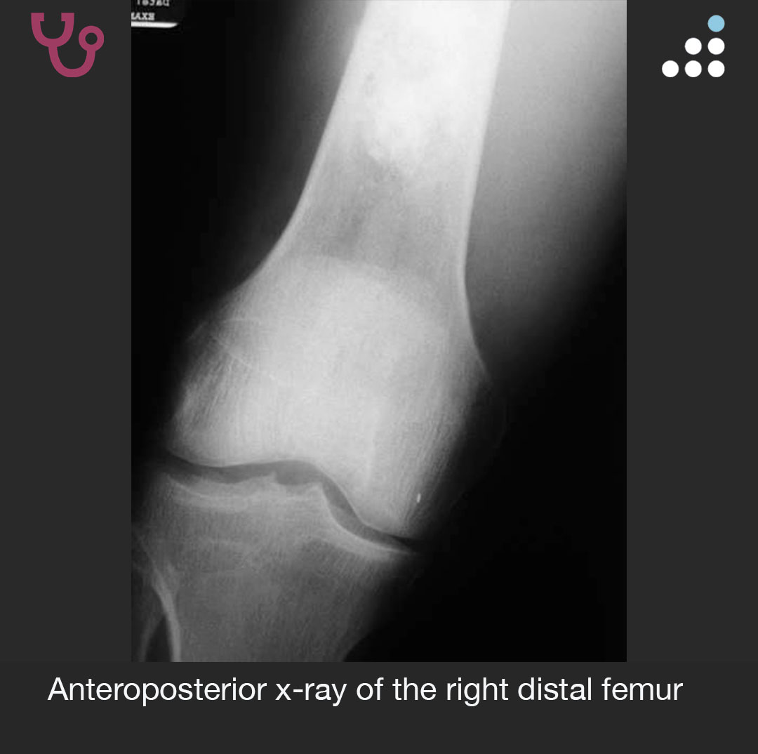 orthobullets's tweet image. Here is a new case by @DrJamesWittig, Matthew Dumbroff, and Mandala Medical Group.

LEG PAIN AND SWELLING IN 52M

How would you manage this #orthotwitter?

Vote on this case for CME: orthobullets.tiny.us/2s3fccde