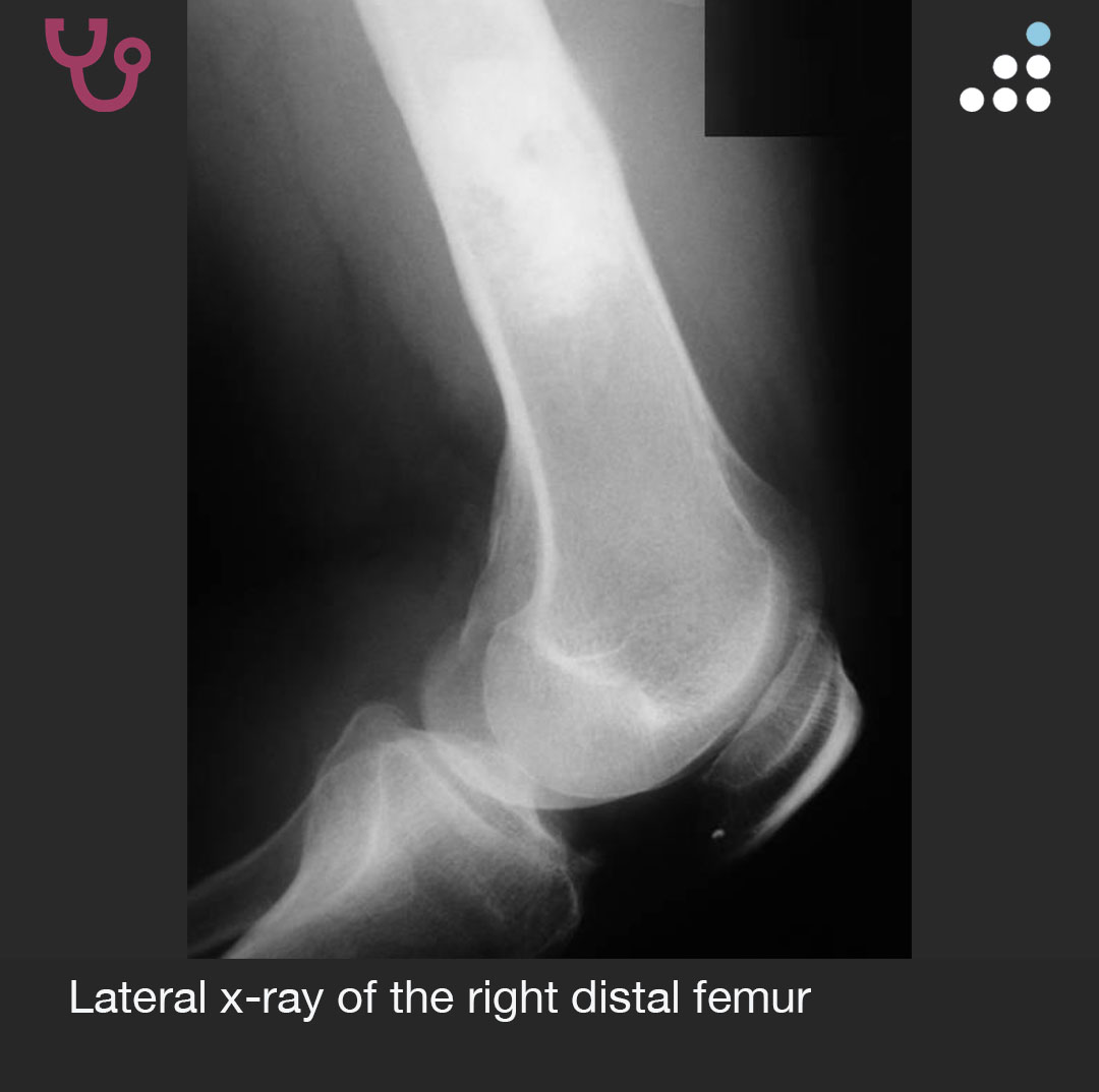 orthobullets's tweet image. Here is a new case by @DrJamesWittig, Matthew Dumbroff, and Mandala Medical Group.

LEG PAIN AND SWELLING IN 52M

How would you manage this #orthotwitter?

Vote on this case for CME: orthobullets.tiny.us/2s3fccde