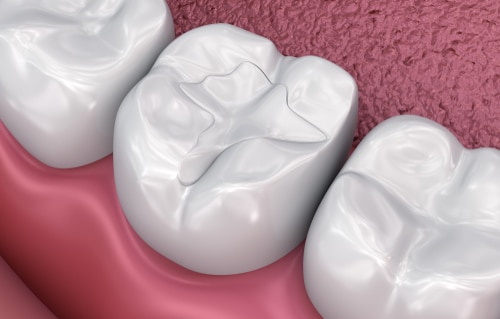 guldandds's tweet image. Dental fillings can prevent the spread of bacteria or plaque which can lead to infection. Call Dr. Michael Guldan for a tooth colored filling. 
#winthrop #dentalimplants #dentist bit.ly/3Hy099i