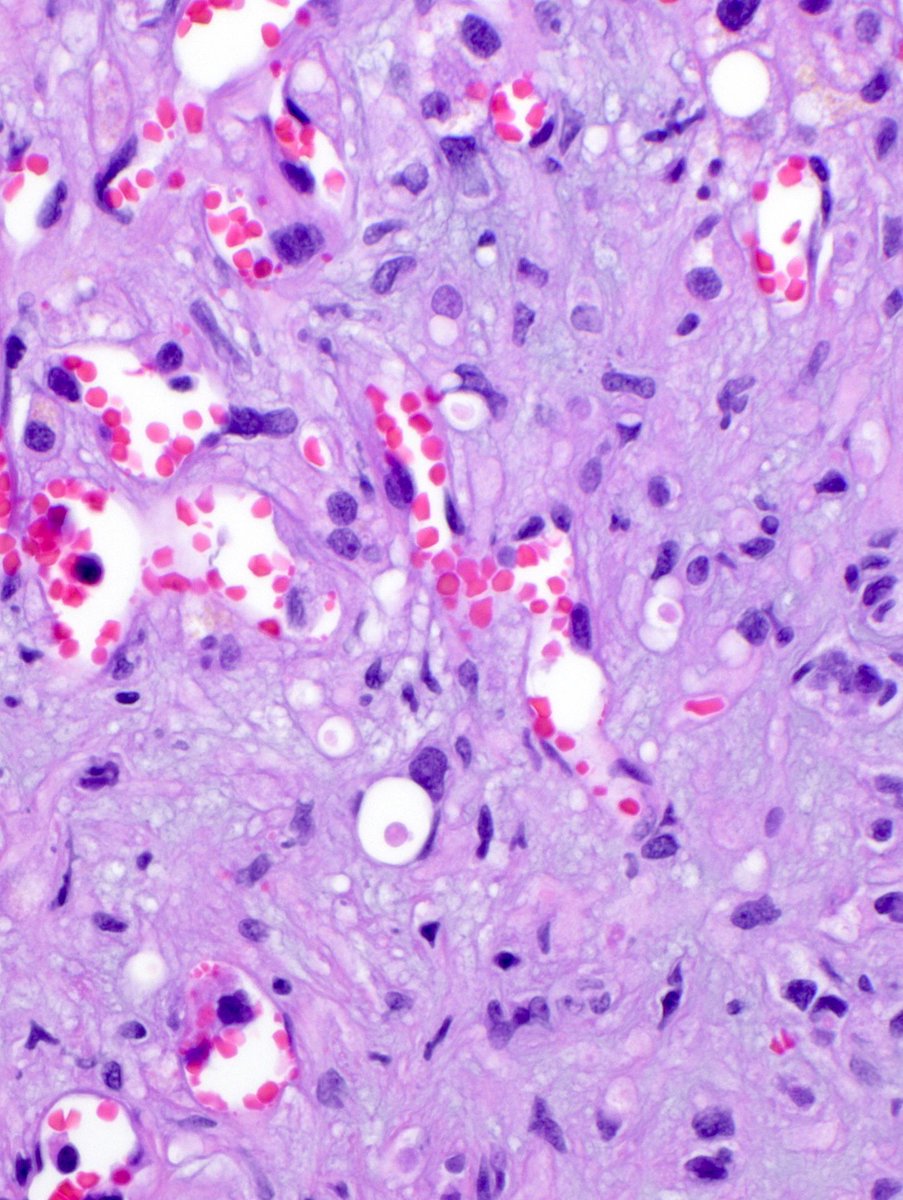 JMGardnerMD's tweet image. Classic morphology!
Can you make the diagnosis from one pic, or is it #TooCloseToDiagnose?
More pics: kikoxp.com/posts/16807 
Answer ⏯️ youtube.com/watch?v=8wKbCL… 
#BSTpath #pathology #pathologists #pathTwitter #dermpath #dermatology #dermatologia #dermtwitter