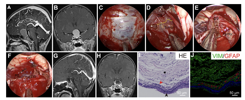 TheJNS's tweet photo. #OnlineFirst: Endoscopic endonasal surgery for infradiaphragmatic craniopharyngiomas: the impact of diaphragma sellae resection. 

https://t.co/qmnWokGdNL https://t.co/bL3nrg7GiX