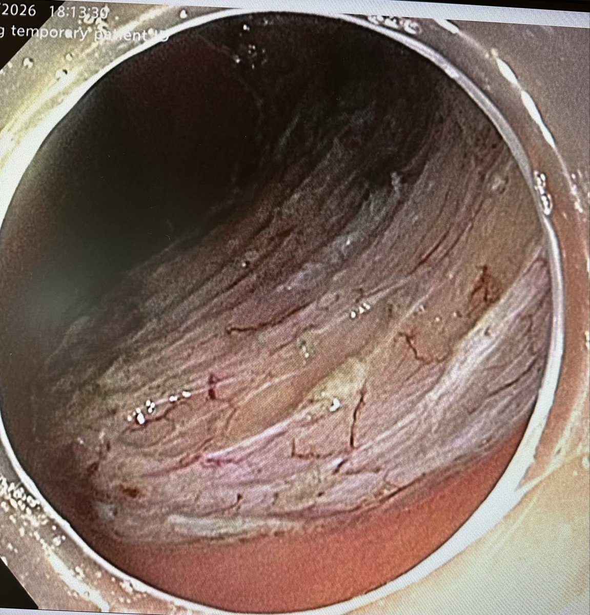 AhmedAlemamMD's tweet image. Great week of advanced cases!
#GITwitter #endoscopy #esd #ERCP #EUS
@ASGEendoscopy @AmCollegeGastro @GIE_Journal