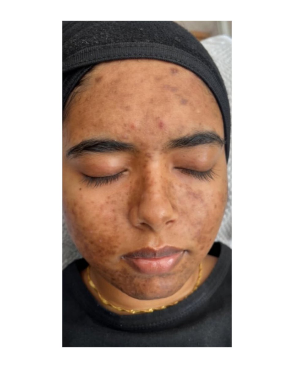 NoFilterSkin's tweet image. #BeforeAndAfter