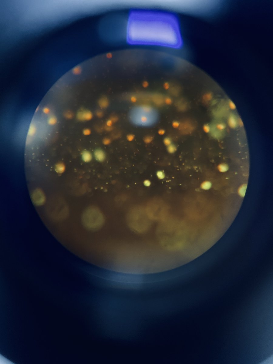 Today’s World Malaria Day. A little reminder from the lab…. Specimen quality,  QC, and validated methods aren't boring they're what stands between a missed diagnosis and a saved patient. Malaria elimination depends on the MLS excellence. Malaria parasites from my lens.