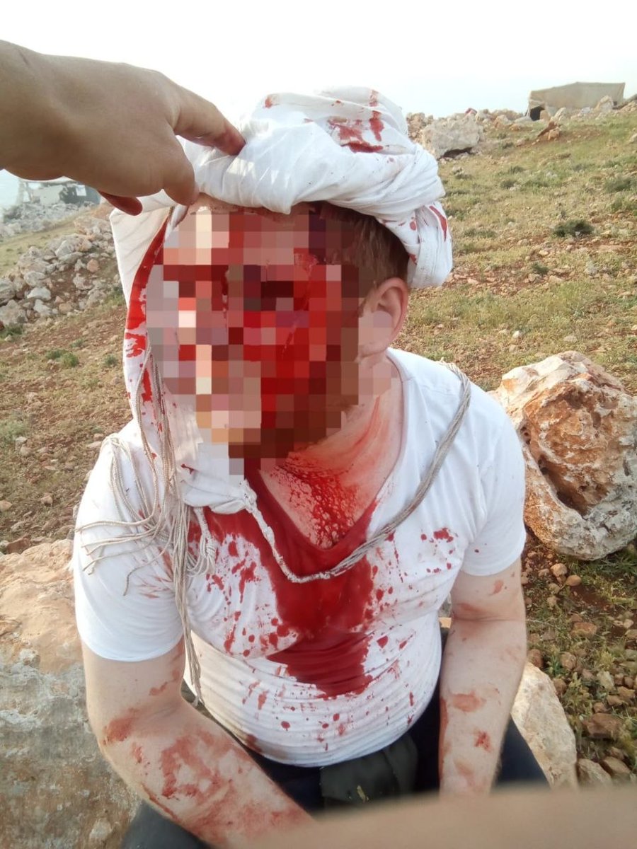 הצלה יו"ש ללא גבולות : עידכון : הבוקר סמוך לשעה 7:00 פורעים ערבים מדומא תקפו באלות ואבנים רועה צאן יהודי מחוות גיבורי דוד ( לזכרו של דוד ליבי הי"ד) בשטחי מרעה פונה לשערי צדק עם *שבר בגולגולת*

בארוע נוסף בגזרת דומא סמוך לשעה 9:40  ערבי התנגש במכוון ברינג'ר בו נהג בעל חוות מכתם