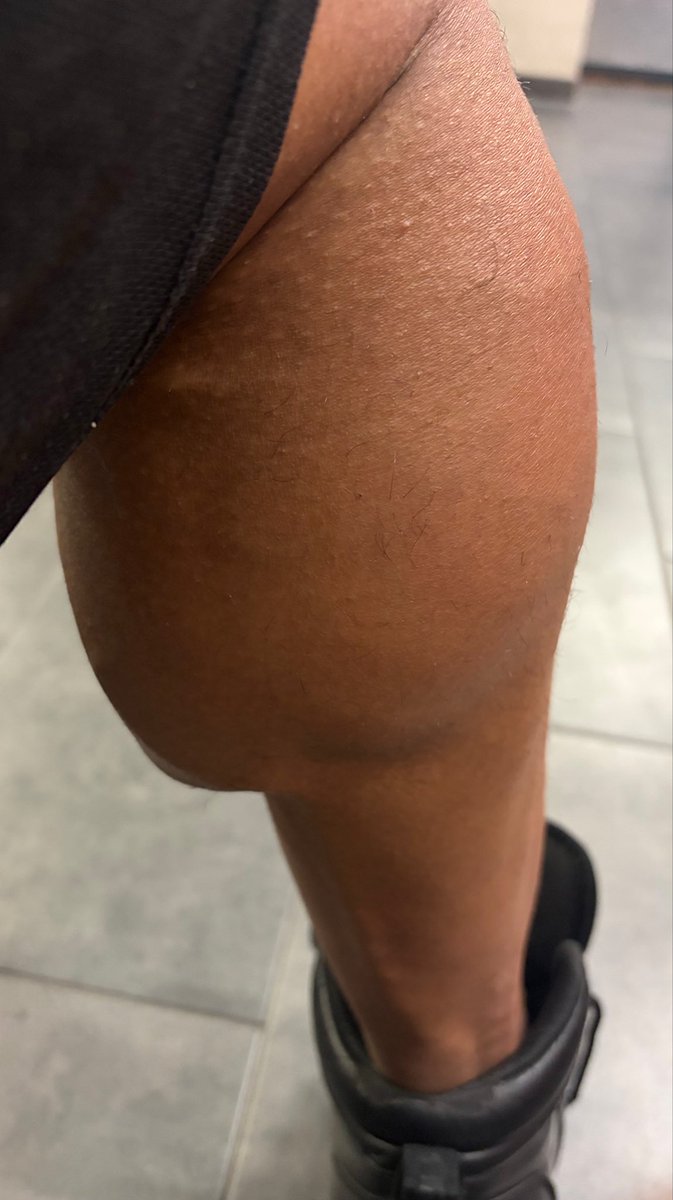 IronCrushX's tweet image. I always train calves and hamstrings together, separate from quads - gives each muscle group the full attention it needs to grow 💪🏽😈
#muscle #bodybuilding