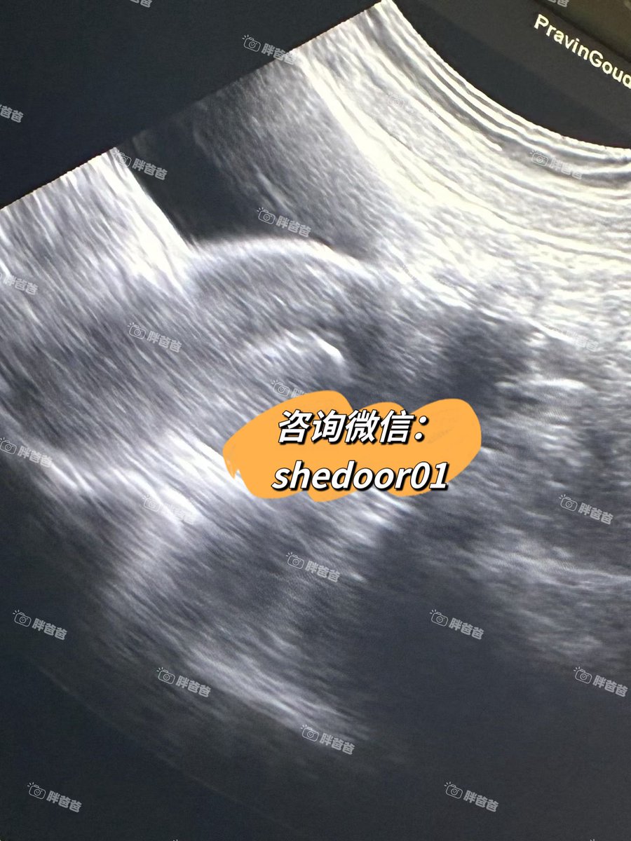 VeraKps's tweet photo. 又一位爱心妈妈顺利完成移植啦✅
从匹配成功到移植，每一步都经过医生严格把关和审核，合格了才能进入最终阶段。
感谢麻麻的积极配合，也谢谢准父母的耐心等待
海外代孕 单身未婚试管婴儿 白人模特实名精子库卵子库 高龄大龄卵巢早衰 胎停流产试管 https://t.co/Dl37ZtPnHG