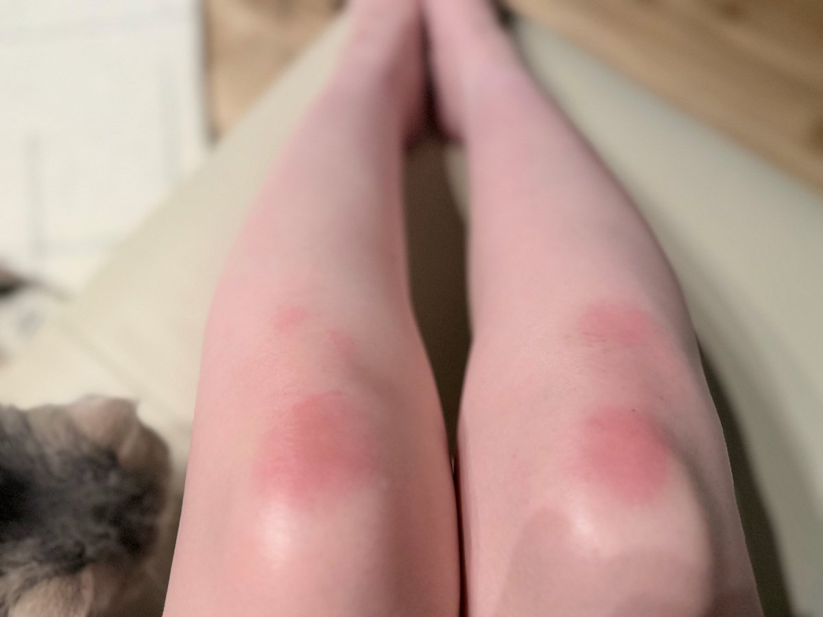 トークの時、立て膝ついてたら
こうなりました😂
次回から空気椅子でやろう…(耐久)