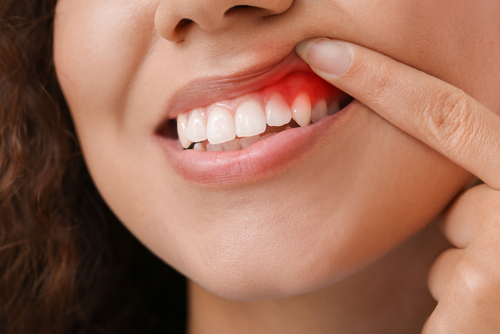 SunshineDentaI's tweet image. Bleeding gums are an early warning sign. See why early treatment matters and how gum disease can still be reversed. #Albuquerque #Implant #Dentist bit.ly/4aV2ut2