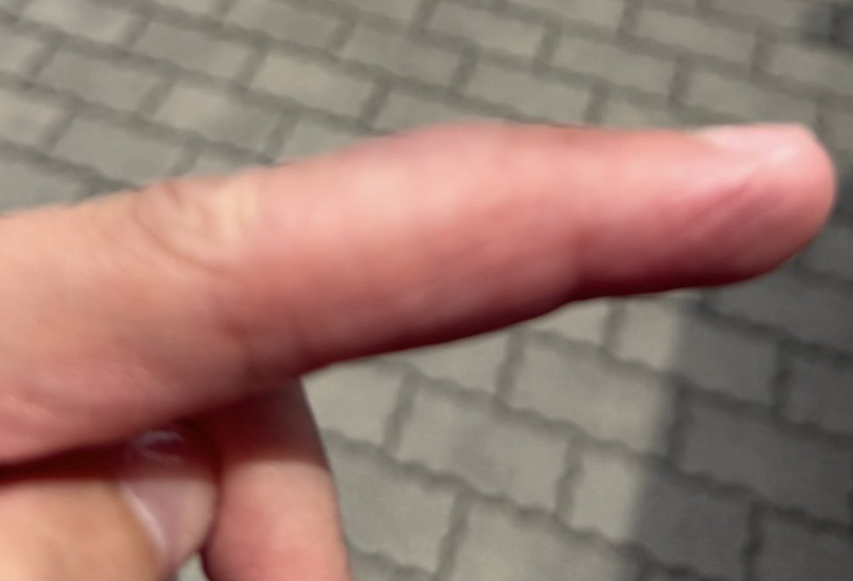 gripapple's tweet photo. マレットフィンガー経過
左中指の腱が断裂してから2ヶ月ほど経ったが、少しずつ回復。
トレーニーとかグリップマンとしてではなく、ごく普通の人間レベルでかなり問題があるレベルから半年リハビリをして、ごく普通のレベルまでしか回復しない見込み。
正常な右手と比べると腫れているが、マシになる。 https://t.co/0yKpDfFG1y