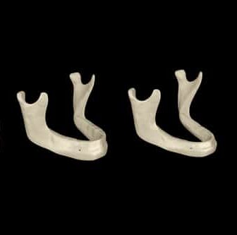 rickmillerdds's tweet image. Watch this video by Dr. Rick Miller, an experienced Dallas dentist, as he discusses alternate implant options for those with bone resorption. #dallas #dentalimplants #dentist bit.ly/42vt7QK