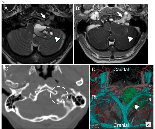 TheJNS's tweet photo. #JNSCaseLessons. Researchers highlight minimally invasive treatment strategy combining partial resection with cyst aspiration and subsequent Gamma Knife radiosurgery for cystic hypoglossal neurinoma in an older adult. 

https://t.co/AcG6cVVh7z https://t.co/IYpFy6PEFo