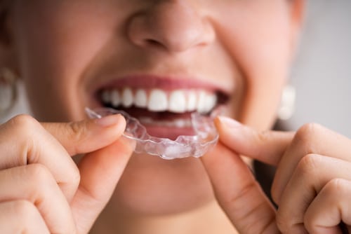 johnhopkins_dds's tweet image. Watch this video to learn more about the time frame you can expect to align your smile using clear braces. #gulfport #implant #dentist bit.ly/3uwuF0i