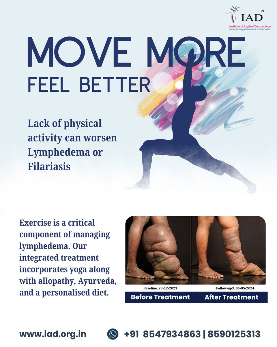 iadorgin's tweet image. Did you know? A lack of physical activity can worsen lymphedema or filariasis. That’s why we’ve incorporated yoga into our integrated treatment approach. #lymphedema #yoga 
@MoHFW_INDIA @moayush @NTDFreeIndia @WHO